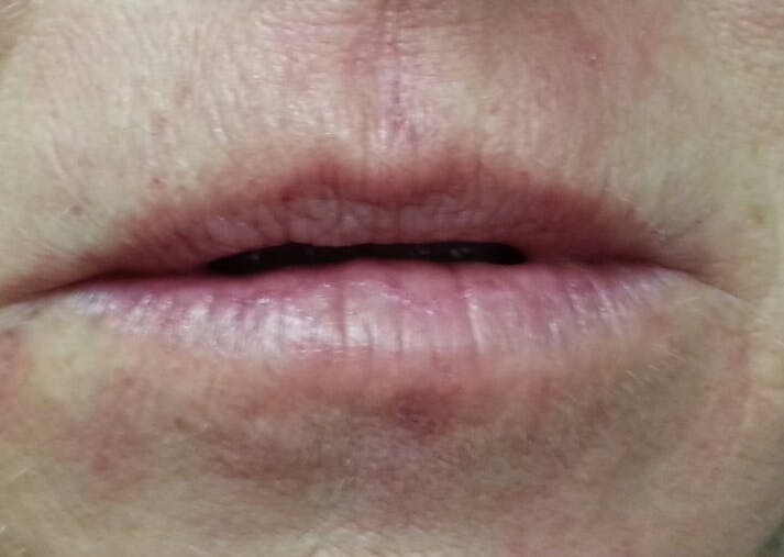 Before image Immediately after 1cc Restylane