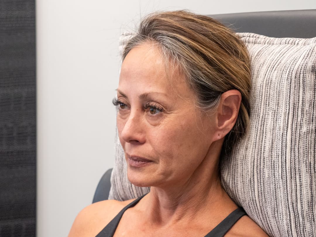 Before image Before 6cc of Restylane filler