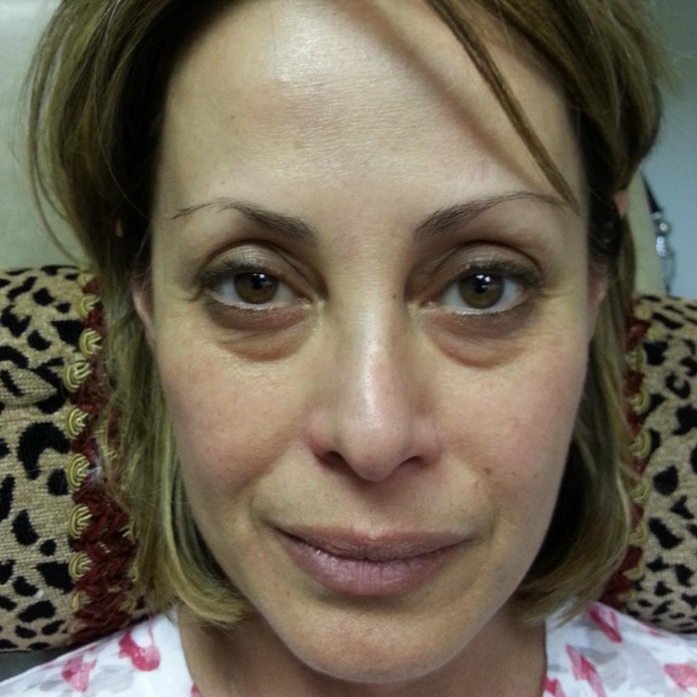 Before image Received 2 cc Restylane in tear troughs (before)
