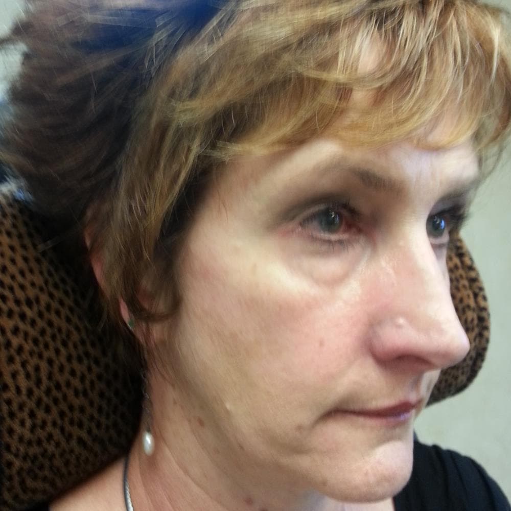 Before image Before Injections