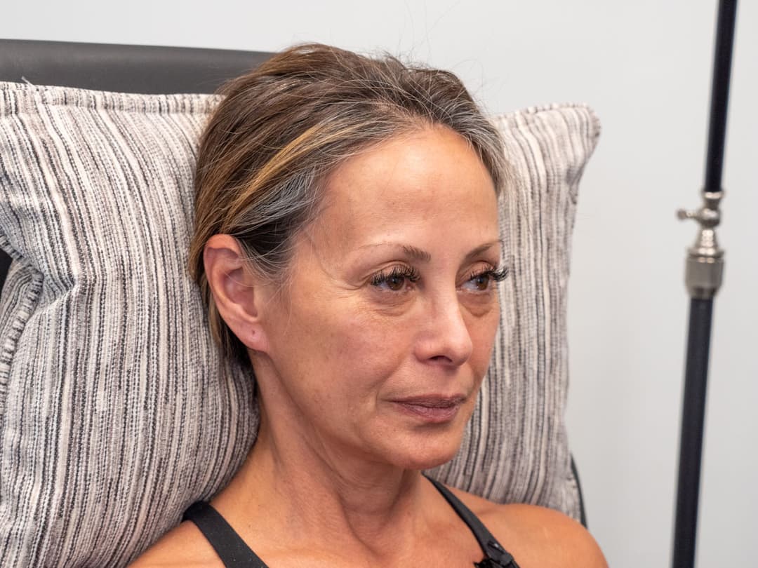 Before image Before 6cc of Restylane filler