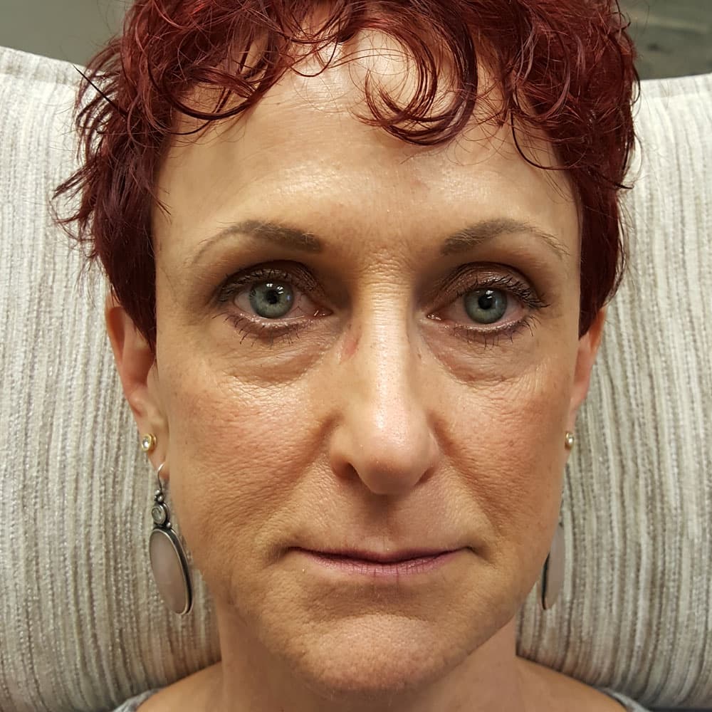 Before image 2 weeks after 6 syringes of Restylane Lyft