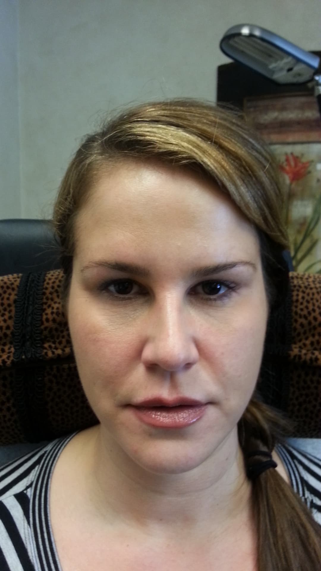 Before image 2 cc’s Restylane in the tear troughs and 3 cc’s Restylane Lyft in the cheeks, corners of the mouth, and jowls. (after)