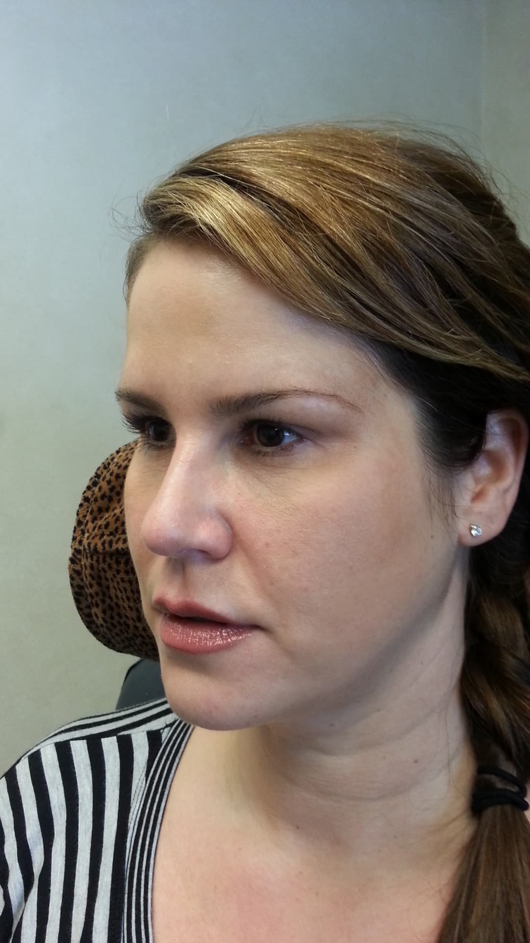 Before image After 2 cc’s Restylane in the tear troughs and 3 cc’s Restylane Lyft in the cheeks, corners of the mouth, and jowls.