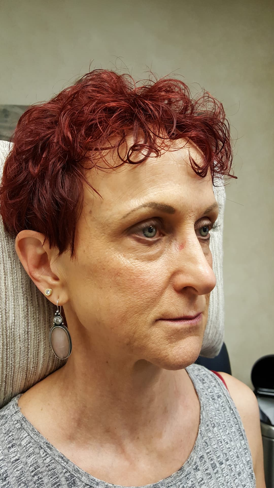 Before image 2 weeks after 6 syringes of Restylane Lyft
