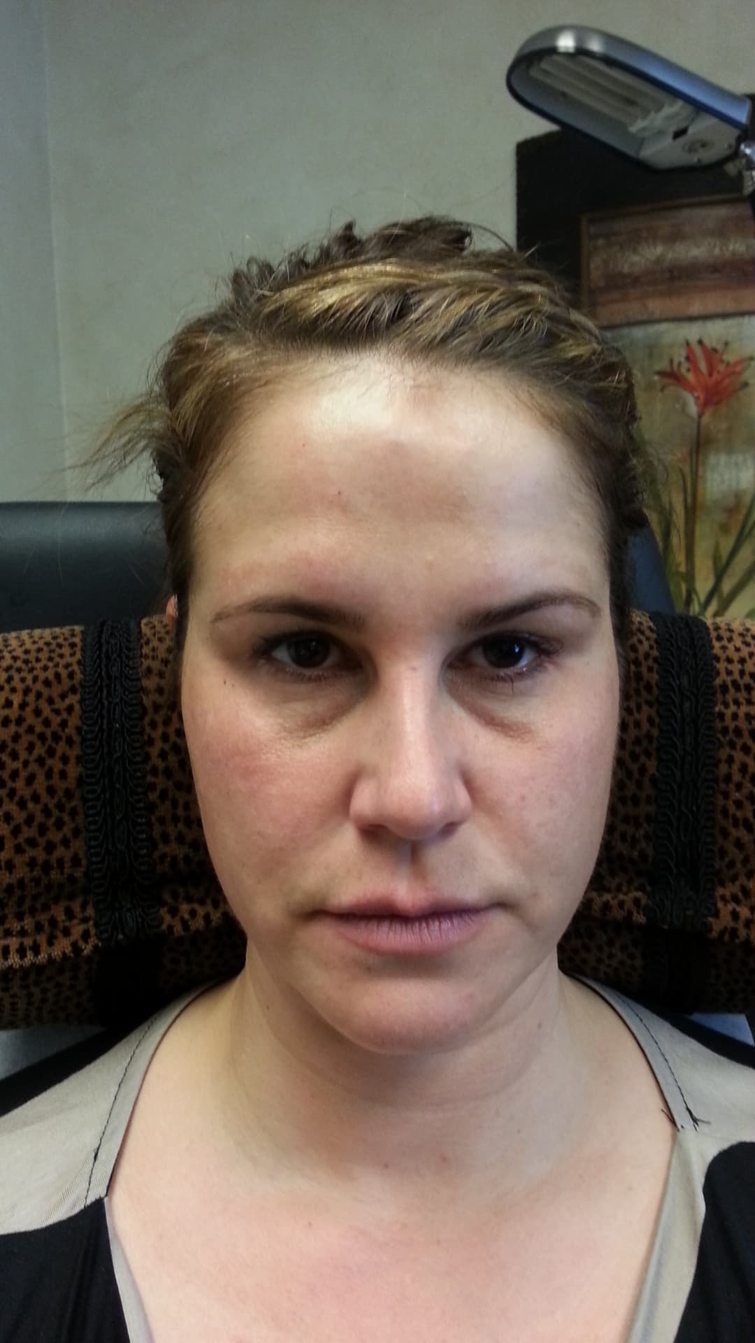 Before image 2 cc’s Restylane in the tear troughs and 3 cc’s Restylane Lyft in the cheeks, corners of the mouth, and jowls.