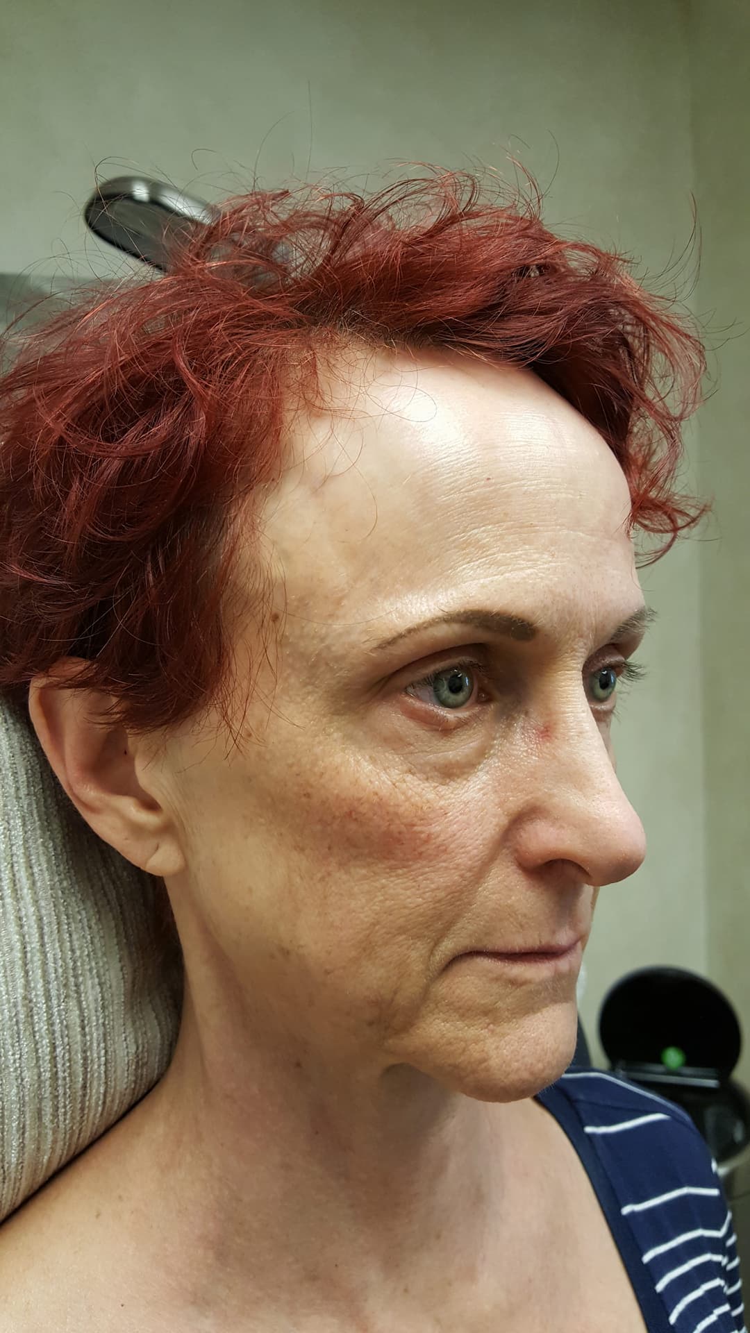 Before image 2 weeks before 6 syringes of Restylane Lyft